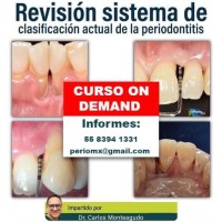 Revisión sistema de clasificación actual de la periodontitis 